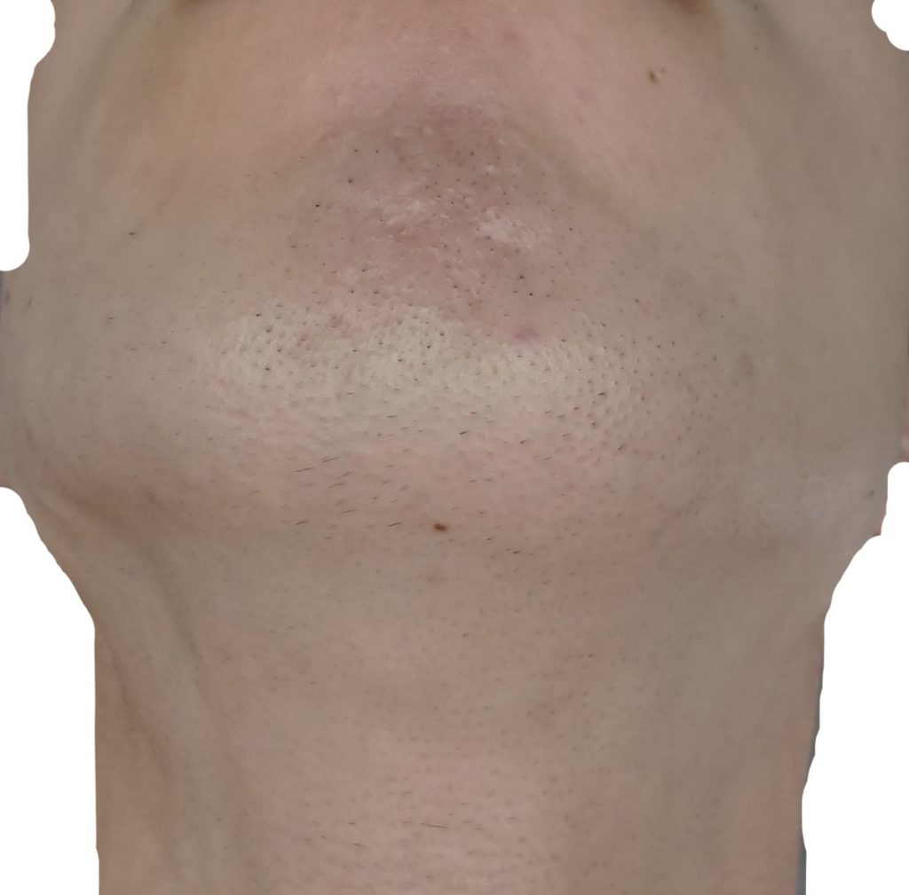 顎下脱毛7回目直前24時間後