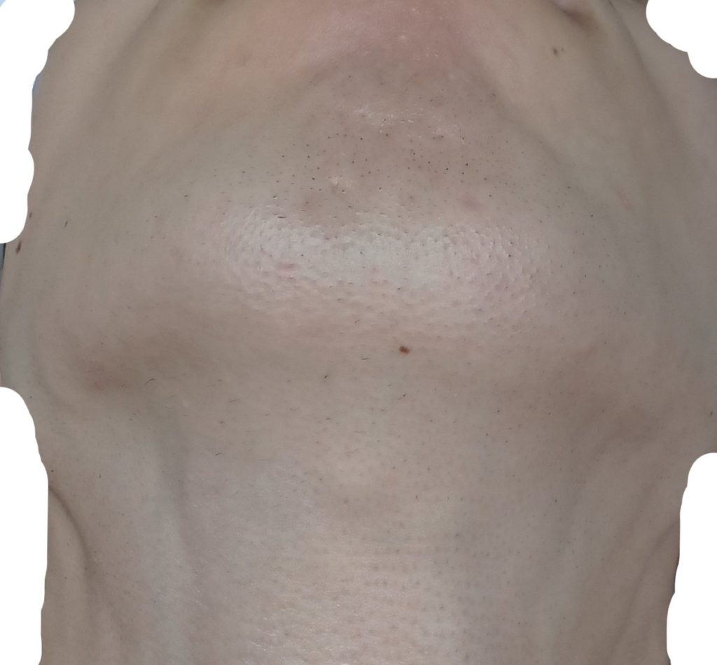 顎下脱毛８回目照射後から２週間後の２４時間後