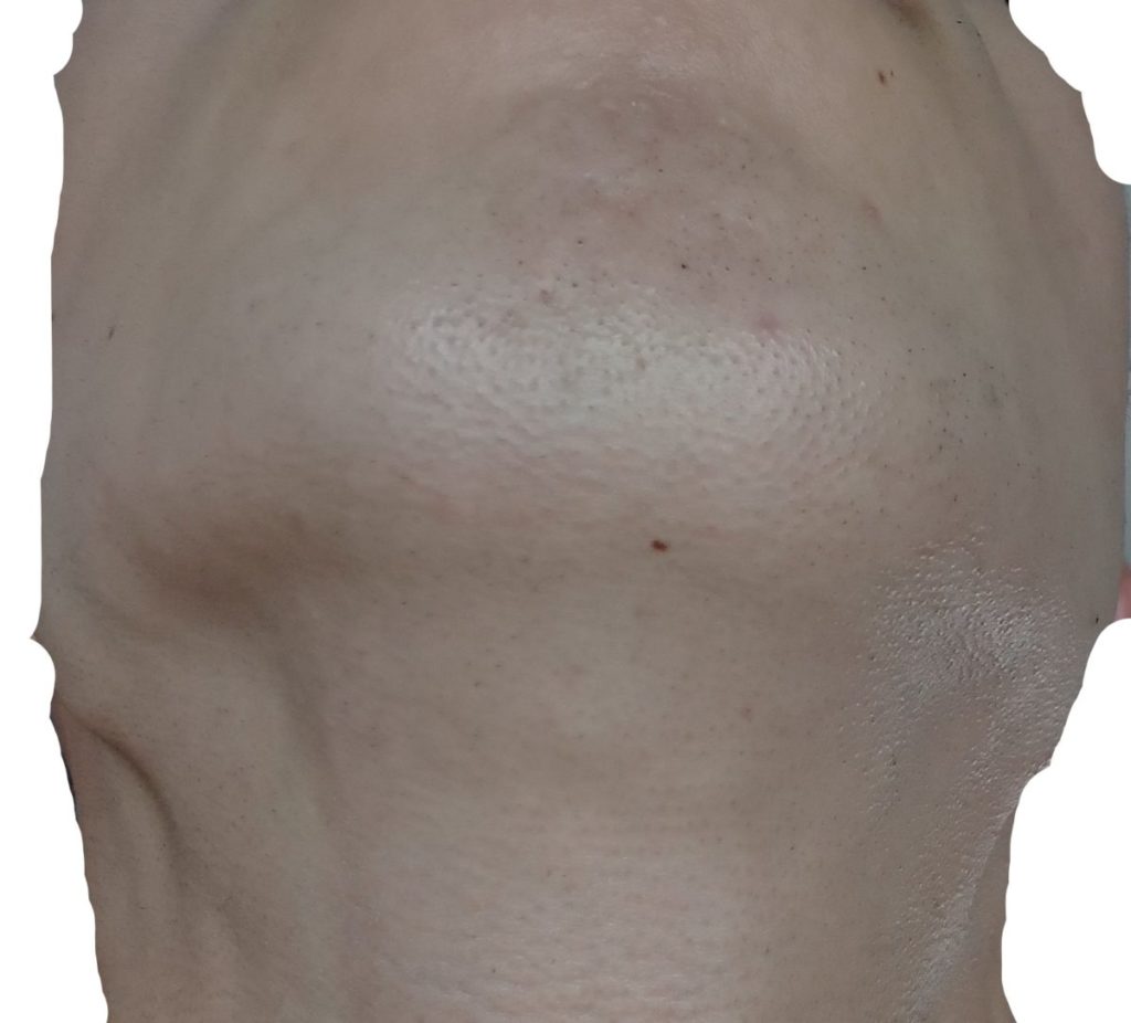 顎下脱毛７回目２４時間後