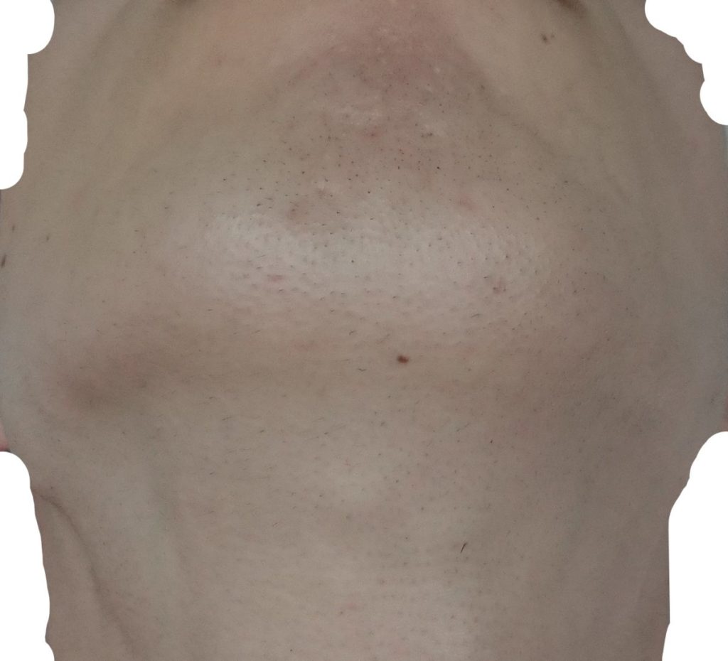 あご下脱毛８回目照射後から３週間後