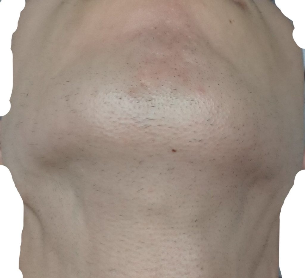 顎下脱毛８回目２４時間後