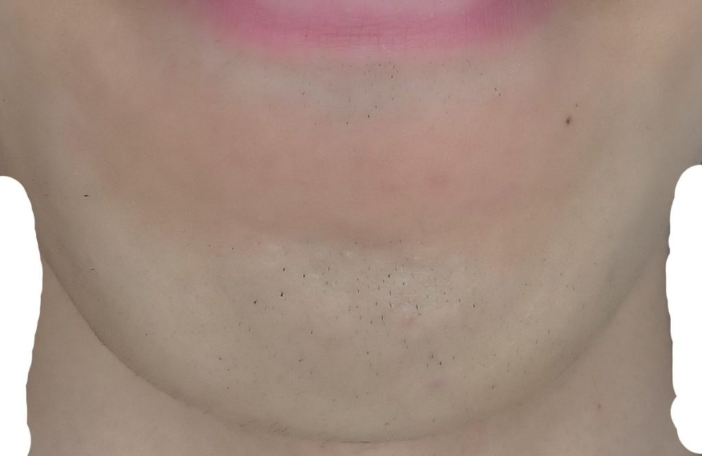 あご脱毛7回目直前24時間後