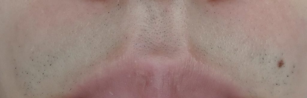 鼻下脱毛7回目直前24時間後