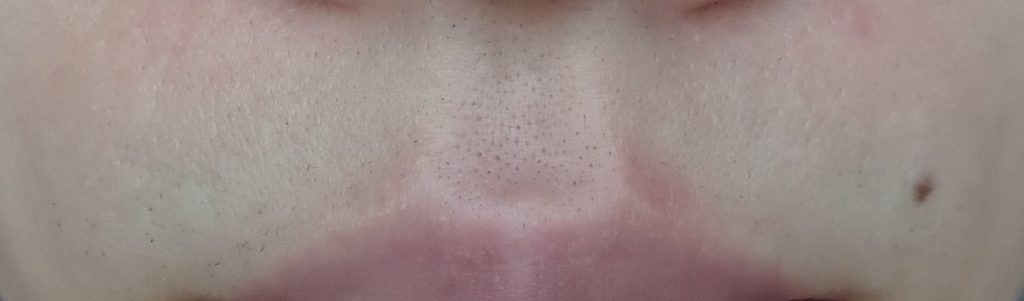 鼻下脱毛８回目照射後から２週間後の２４時間後