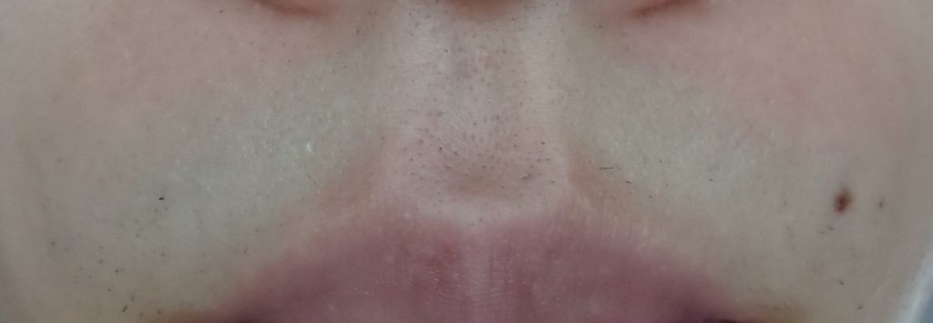 鼻下脱毛７回目２４時間後