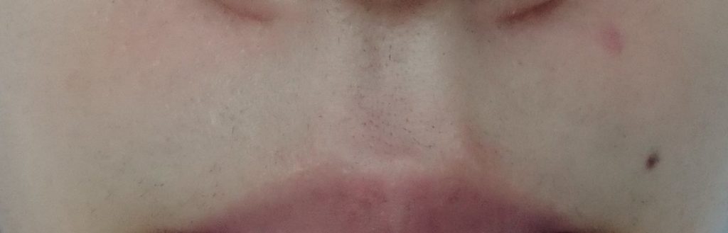 鼻下脱毛８回目照射後から３週間後