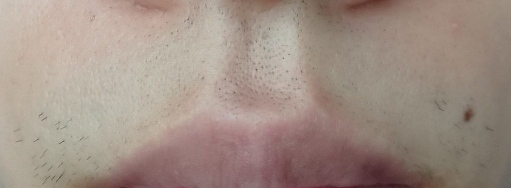 鼻下脱毛８回目７２時間後