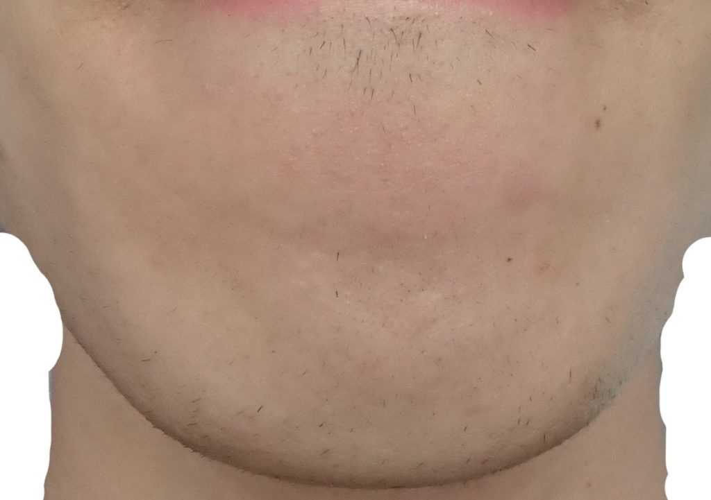 あご9回目脱毛直前の剃毛24時間後