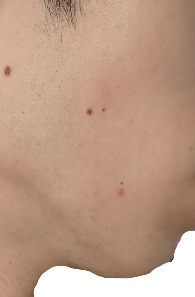 右もみあげ9回目脱毛直前の剃毛24時間後