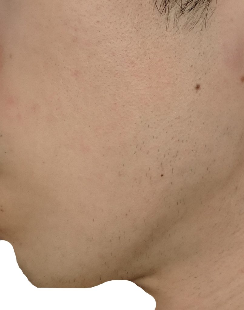 左もみあげ9回目脱毛直前の剃毛24時間後