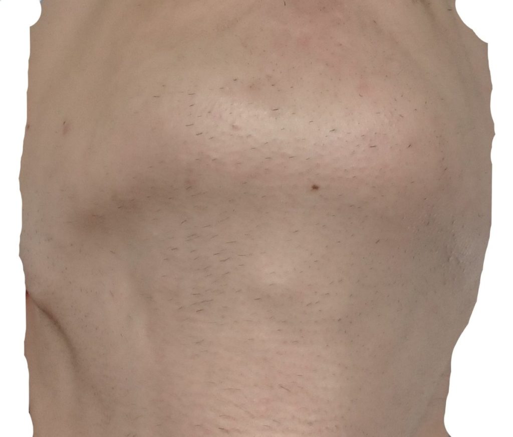 顎下9回目脱毛直前の剃毛24時間後