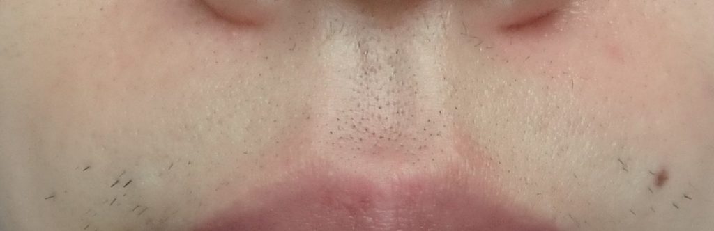 鼻下9回目脱毛直前の剃毛24時間後