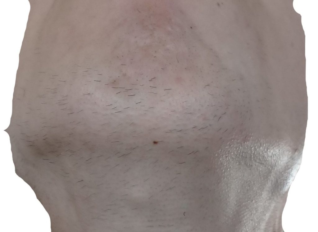 顎下脱毛10回目直前の剃毛1週間後