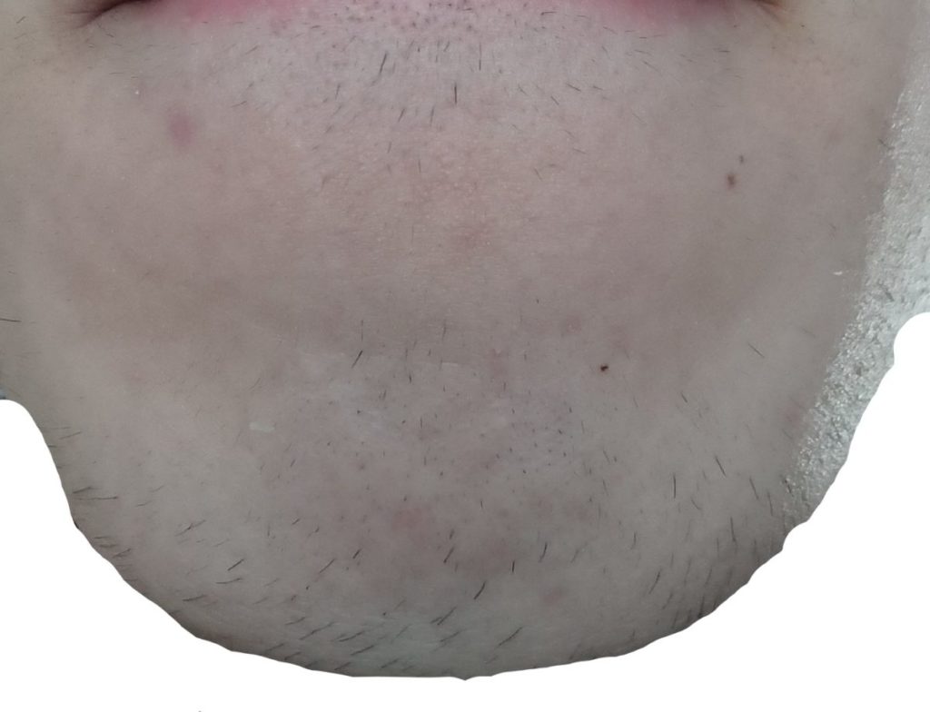 顎脱毛10回目直前の剃毛1週間後
