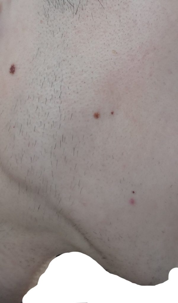 右もみあげ脱毛10回目直前の剃毛1週間後