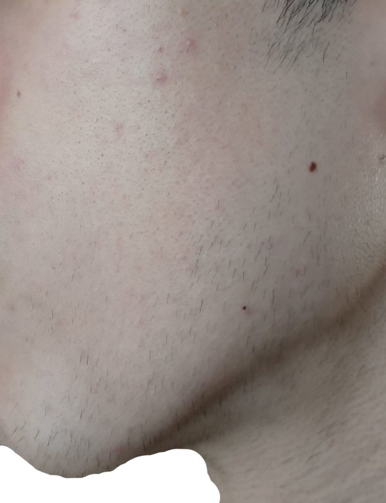 左もみあげ脱毛10回目直前の剃毛1週間後