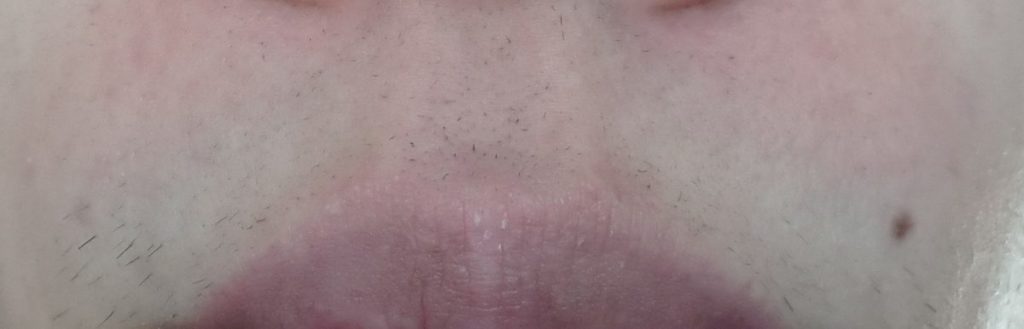 鼻下10回目脱毛開始直前の剃毛1週間後