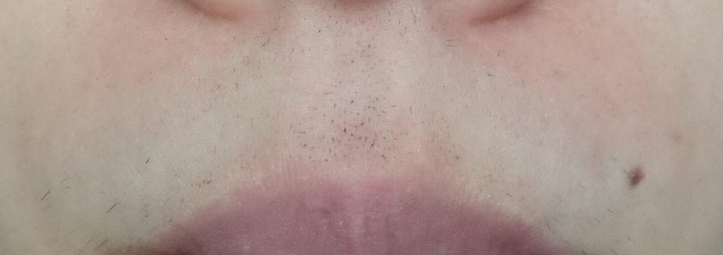 鼻下11回目脱毛開始直前の剃毛1週間後