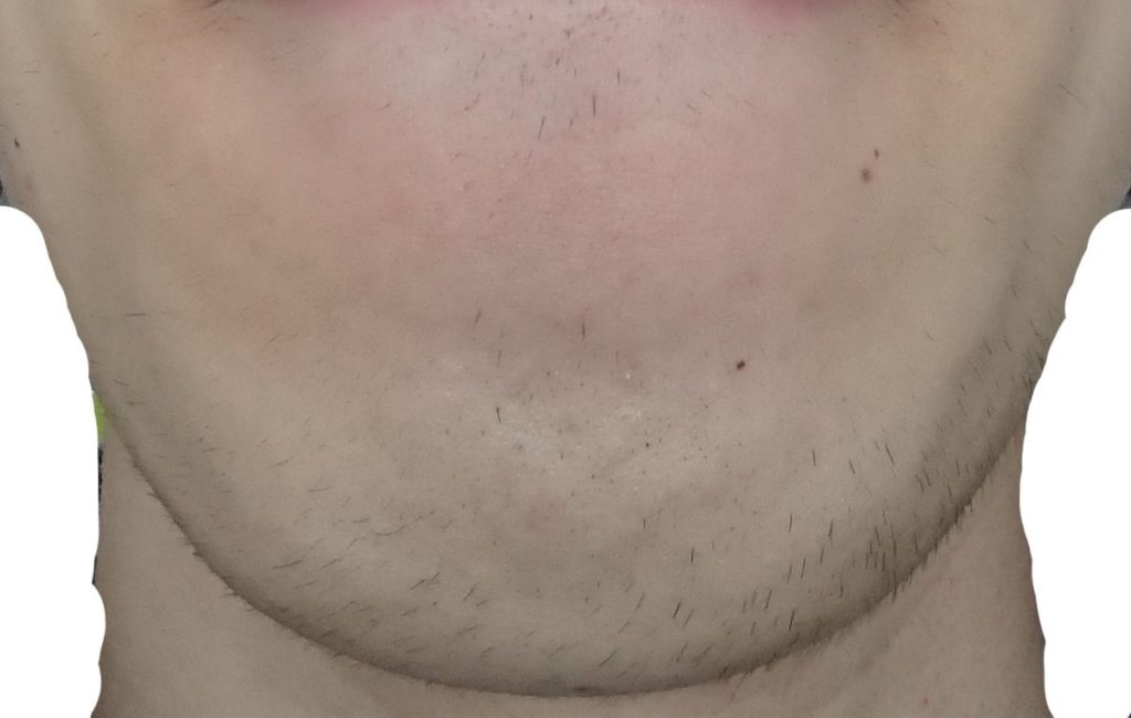 あご11回目脱毛開始直前の剃毛1週間後