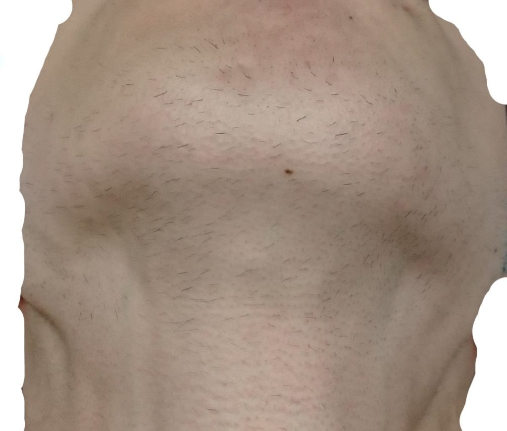 あご下11回目脱毛開始直前の剃毛1週間後