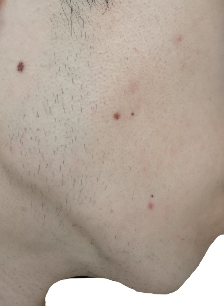 右もみあげ11回目脱毛開始直前の剃毛1週間後