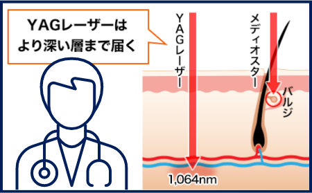 ゴリラクリニックのYAGレーザー図