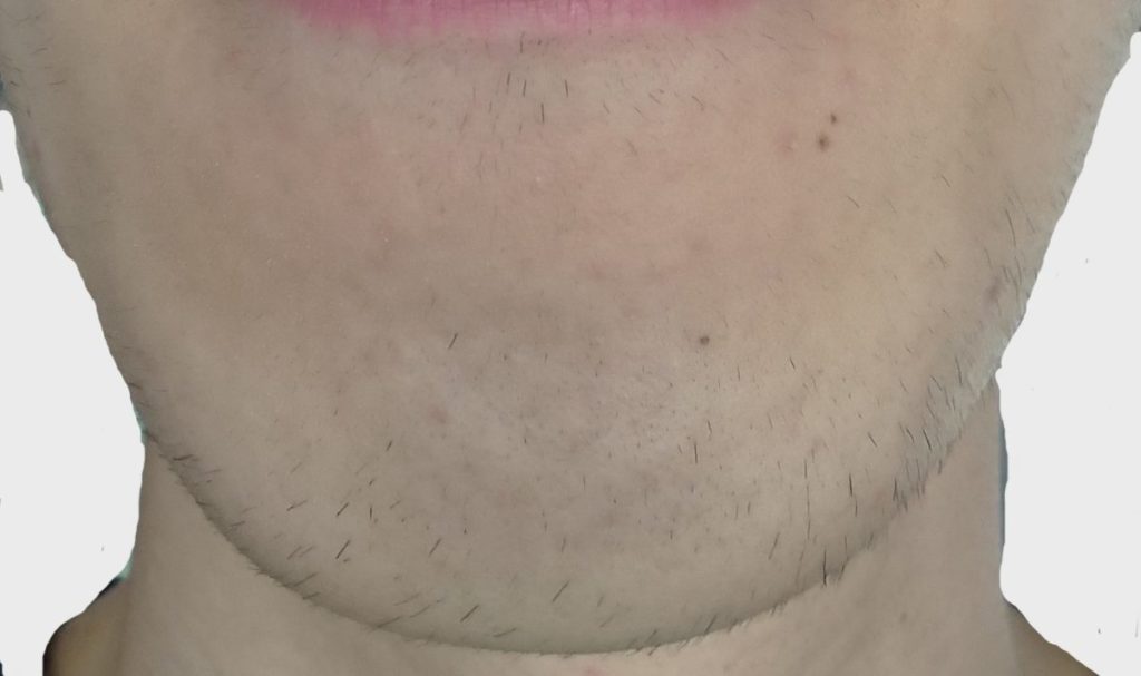 あご12回目脱毛開始直前の剃毛1週間後